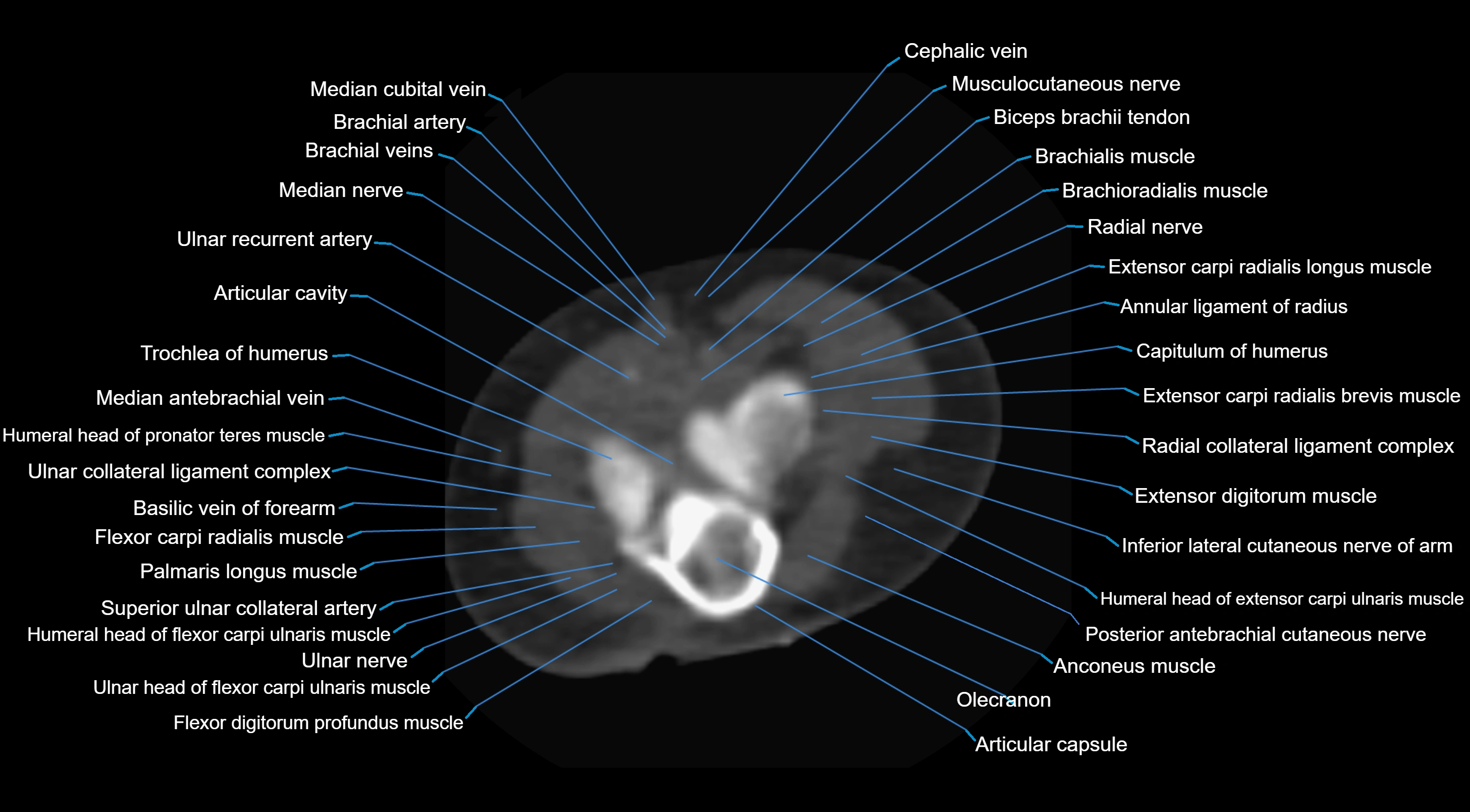 CT elbow axial  cross sectional anatomy labelled  radiology image -00027.webp